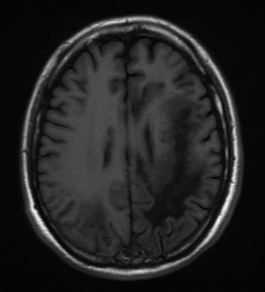 RMI: T1 axial sin gadolinio: imagen hipointensa subcortical en región paraventricular izquierda, afectando lóbulos parietal y occipital, con edema y desplazamiento de surcos cerebrales.
