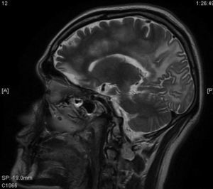 RMI: T2 sagital: extensa lesión que compromete lóbulo frontal hasta lóbulo occipital izquierdo, con áreas hiperintensas subcorticales y prominencia de surcos cerebrales en lóbulo parieto-occipital.