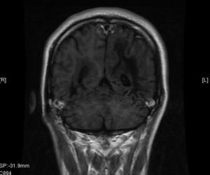 RMI: T1 coronal: imágenes hipointensas en lóbulo occipital derecho y parieto-occipital izquierdo, adyacentes a ambos ventrículos laterales.