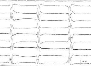 EEG de control evolutivo: paroxismo-supresión (cese de las crisis clínicas).