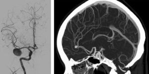 Arteriografía (aneurisma de arteria cerebral media) y angio-TC (aneurisma de arteria cerebral anterior).