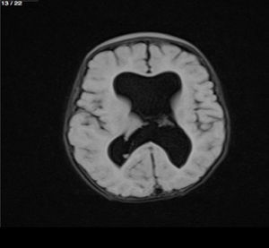 Imagen en T1 donde se observan ventriculomegalia y ausencia del cavum pelúcido.