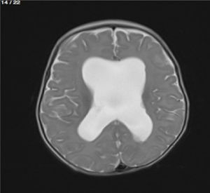 Imagen en T2 donde se observan ventriculomegalia y ausencia del septum pelúcido.