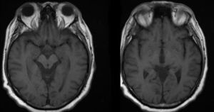 RM de encéfalo de paciente FV con diagnóstico de encefalitis por anticuerpos anti-LG1.