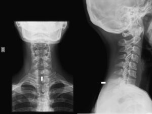 Radiografía cervical. Espina bífida oculta a nivel de C7 en paciente de 22 años de edad, tratándose de un hallazgo casual.
