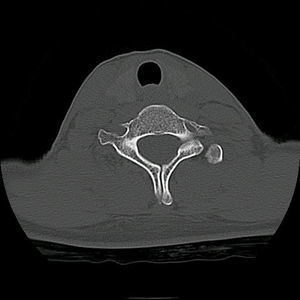 TC cervical. Déficit de fusión a nivel de arco vertebral posterior de C7 en paciente de 22 años de edad, tratándose de un hallazgo casual.