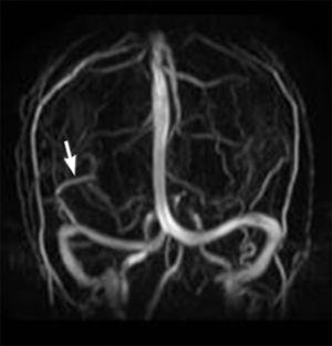 Angio-RM de cerebro con tiempo venoso. ADV (flecha) con drenaje en seno lateral derecho.