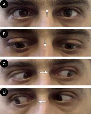 A) Parálisis de la elevación de la mirada con aparición de nistagmo convergente retractorio. B) Depresión de la mirada comprometida en menor grado que la elevación. C y D) Indemnidad de la mirada lateral. Las flechas indican la dirección de la mirada.
