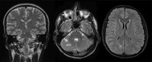 Resonancia magnética encefálica. Se observan múltiples lesiones isquémicas de la circulación vertebro-basilar hiperintensas en secuencias T2 y FLAIR.