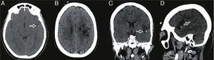 TC de cerebro sin contraste, cortes axiales (A y B), coronal (C) y sagital (D). Imagen cálcica (→) en segmento M3 de la ACM izquierda asociada a hipodensidad córticosubcortical fronto-insular izquierda correspondiente a infarto cerebral agudo-subagudo.