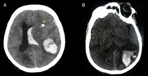 A) TC axial que revela un hematoma parenquimatoso que se extiende en lóbulos frontal-temporal-parietal izquierdo y dentro del sistema ventricular homolateral. Signos de edema cerebral extenso; se observa desviación de la línea media (la flecha señala el catéter de monitorización de presión intracraneana). B) TC axial que revela un hematoma en los lóbulos parietal y occipital izquierdo con efecto hematocrito.