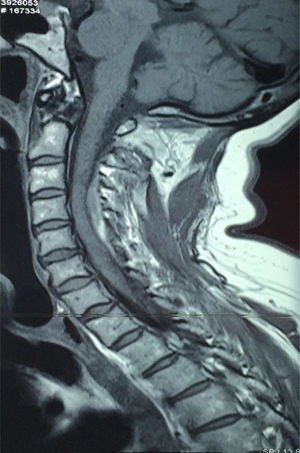 TC cervical: hematoma epidural: imagen densa, en región extraaxial postero-lateral izquierda, convexa hacia el canal raquídeo que desplaza el saco tecal.