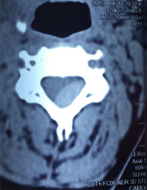 RM cervical, dorso lumbar: secuencia T1, STLR y T2 en plano sagital. Se observa imagen anormal localizada en el canal raquídeo, ocupa el sector extradural, postero-lateral izquierdo del canal, desde C3 a C5, isointensa en T1 e hipointensa en T2.