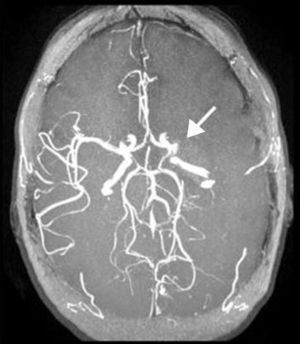 Angio-RM donde se muestra detección de flujo en el origen de la arteria cerebral media izquierda.
