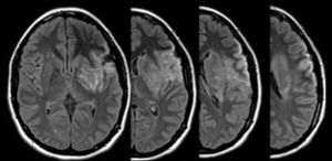 RM secuencia FLAIR donde se evidencia lesión isquémica que compromete el territorio fronto-parieto-insular y ganglios basales a izquierda.
