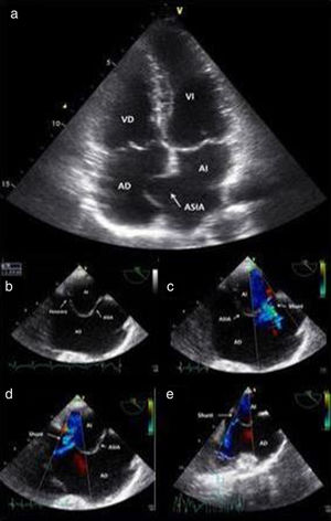 a) Se evidencia el ASIA. B) ETE donde se muestra el ASIA y una de las fenestras. c-e) ETE Doppler donde se muestran los 3 shunts que componen el DSIA multifenestrado.
