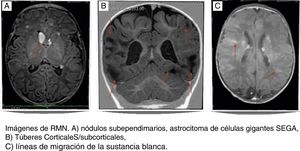 Lesiones del SNC asociadas a esclerosis tuberosa.