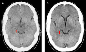 TC de encéfalo sin contraste. Signo de la ACP hiperdensa. Hiperatenuación lineal de la ACP derecha, dentro de la cisterna ambiens (segmento P2), medial a la tienda del cerebelo (flechas).