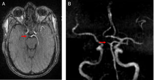 Angiografía por RM de vasos intracraneales. Oclusión completa del segmento precomunicante (P1) de la ACP derecha (flechas).