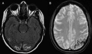 RM de cerebro cortes axiales, secuencias T2 (A) y T2* (B): A) Se observa edema vasogénico subcortical en ambos lóbulos occipitales. B) Se aprecia una zona de HSA focal en la convexidad parietal izquierda.