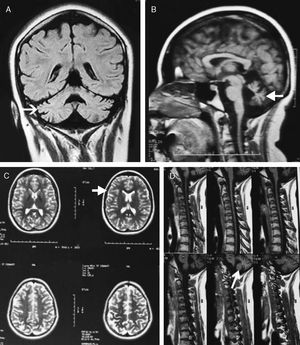 Resonancia magnética cerebral y de columna cervical. A) Atrofia de ambos hemisferios cerebelosos con aumento de las folias cerebelosas. B) Importante atrofia del vermis cerebeloso con aumento del tamaño del iv ventrículo. C) Atrofia cerebral generalizada de predominio cortical, con ensanchamiento de los surcos de la convexidad. D) Gran componente de atrofia cerebelosa a nivel de la fosa posterior.