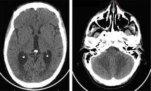 TC de cráneo con contraste iv. Izquierda: áreas hipodensas bilaterales y simétricas a nivel de sustancia blanca cerebral occipital, que no realzan con el medio de contraste (izquierda). Derecha: las mismas lesiones a nivel de la sustancia blanca cerebelosa.