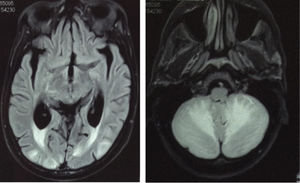 RM de cráneo potenciada en FLAIR, cortes transversales. Se muestran lesiones hiperintensas bilaterales y simétricas a nivel de la sustancia blanca cerebral posterior y cerebelosa, coincidiendo con las lesiones hipointensas en la TC.