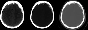 Tomografía cerebral en mismo corte que las secuencias T1 y FLAIR de figura 1, registradas en distintas ventanas de visualización, demostrando de la colección antes descrita densidad cálcica.