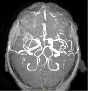 Angio-RM que evidencia estenosis severa suboclusiva del segmento M1 en su tercio distal de la arteria cerebral media derecha con pobre definición del origen de sus ramos de división.