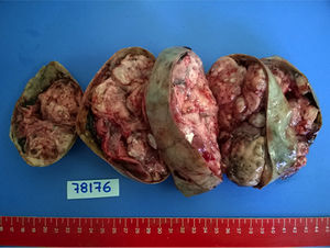 Anatomía patológica. Formación tumoral 16×12×7cm.