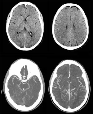 Tomografía cerebral y angiotomografía cerebral realizadas al ingreso.