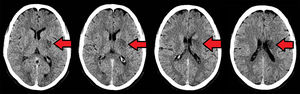 Tomografía cerebral realizada 24 h tras la trombólisis.