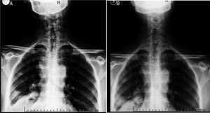 Radiografía de tórax realizada 4 meses antes de la consulta A), y la tomada durante la internación B).