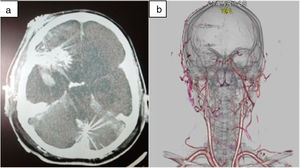 Angio-TAC de cráneo a las 48 horas del ingreso: a) corte axial; b) reconstrucción. Se observa ausencia total de flujo en vasos cerebrales. Falta de llenado del polígono de Willis. Solo se constata flujo en carótida externa.