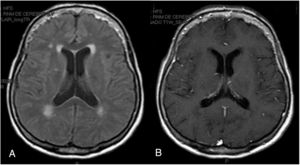 Resonancia cerebral: A) Secuencia FLAIR axial que demuestra hiperintensidades periventriculares compatibles con leucoencefalopatía microangiopática. B) Secuencia T1 axial contrastada en la que no se observan áreas de realce anormal.