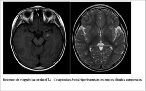 Resonancia magnética cerebral T1: se aprecian áreas hiperintensas en ambos lóbulos temporales.