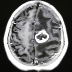RM de cerebro (corte axial, secuencia T1 con gadolinio): lesión focal con refuerzo del contraste en anillo, edema perilesional y efecto de masa sobre las estructuras de la línea media.