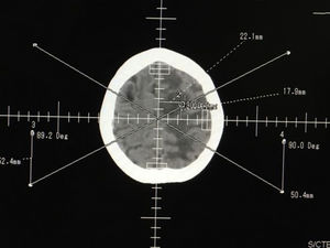 TC de cerebro que muestra marcación previa a la biopsia.