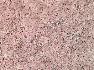 Examen micológico en fresco del material cerebral obtenido: se observan hifas hialinas tabicadas correspondientes a un Eumicete.