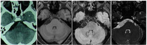 Neuroimágenes del segundo caso en cortes axiales (tomografía axial computarizada (A), resonancia magnética en TFE T1 [B], FLAIR [C] y BFFE [D]). En la secuencia BFFE se visualizan las lesiones quísticas con mejor definición, diferenciándose del líquido cefalorraquídeo.