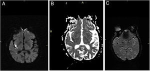 Resonancia magnética de cerebro realizada al ingreso de la paciente, en secuencias DWI, ADC y SWI, respectivamente: a, b y c. En las imágenes a y b se observa un infarto agudo insular derecho. En la imagen c hay un trombo en la porción M2 de la cerebral media derecha.