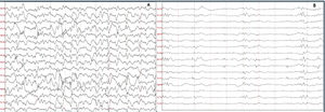 Paciente 2: A) El EEG de ingreso con presencia de actividad epileptiforme de alto voltaje, 2 a 3Hz, generalizada continua compatible con patrón de SE. B) Control sin SE a las 48h en donde se observa ritmo de fondo lentificado sin actividad epileptiforme.