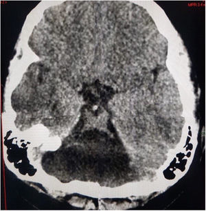 En la tomografía cerebral en vista axial se evidencia el signo del molar que corresponde a hipoplasia vermiana con agenesia de hemisferios cerebelosos bilateral y malformación del tronco encefálico en paciente con síndrome de Joubert.