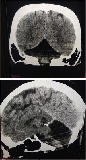 A y B, en la tomografía cerebral en vista coronal y sagital se evidencia agenesia de hemisferios cerebelosos bilateral en paciente con síndrome de Joubert.