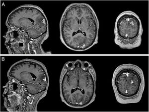 RM cerebral con contraste. A) Imagen prerradioterapia. Lesión extraaxial a nivel parieto-occipital izquierdo con amplia base meníngea, que mide 25×15×13,5mm en coronal, antero-posterior y transversal respectivamente, de bordes regulares y lobulados con significativo realce heterogéneo con el contraste, se proyecta hacia parénquima cerebral adyacente condicionando significativo edema local con predominio en el lóbulo parietal. B) Imagen posradioterapia de 10 meses. Lesión captadora de contraste a nivel de región occipital izquierda de 17×11mm, asociado a edema vasogénico.