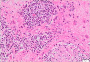 Granulomas no necrotizantes constituidas por algunos histiocitos epitelioides, cúmulos de células gigantes multinucleadas y anillos circundantes de linfocitos y células plasmáticas en medio de un parénquima con gliosis astrocítica leve.