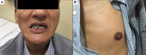 Paciente que presenta hiperpigmentación gingival (A) y mamilar (B).