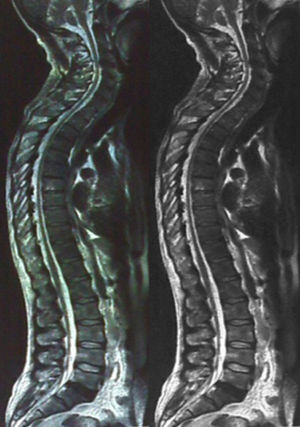 Resonancia magnética con ventana panorámica de la médula espinal.