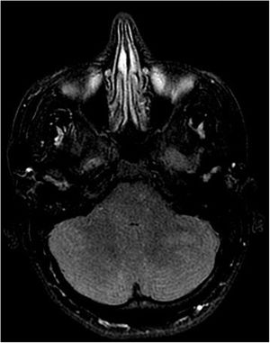 Protuberancia y cerebelo. Corte axial en secuencia T2-Flair con contraste.