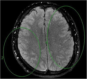 Hemisferios cerebrales. Corte axial en secuencia T2-Flair con contraste.